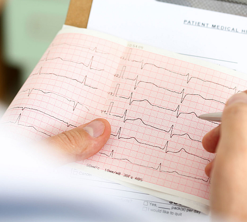 Ecg Lead Placement Chart